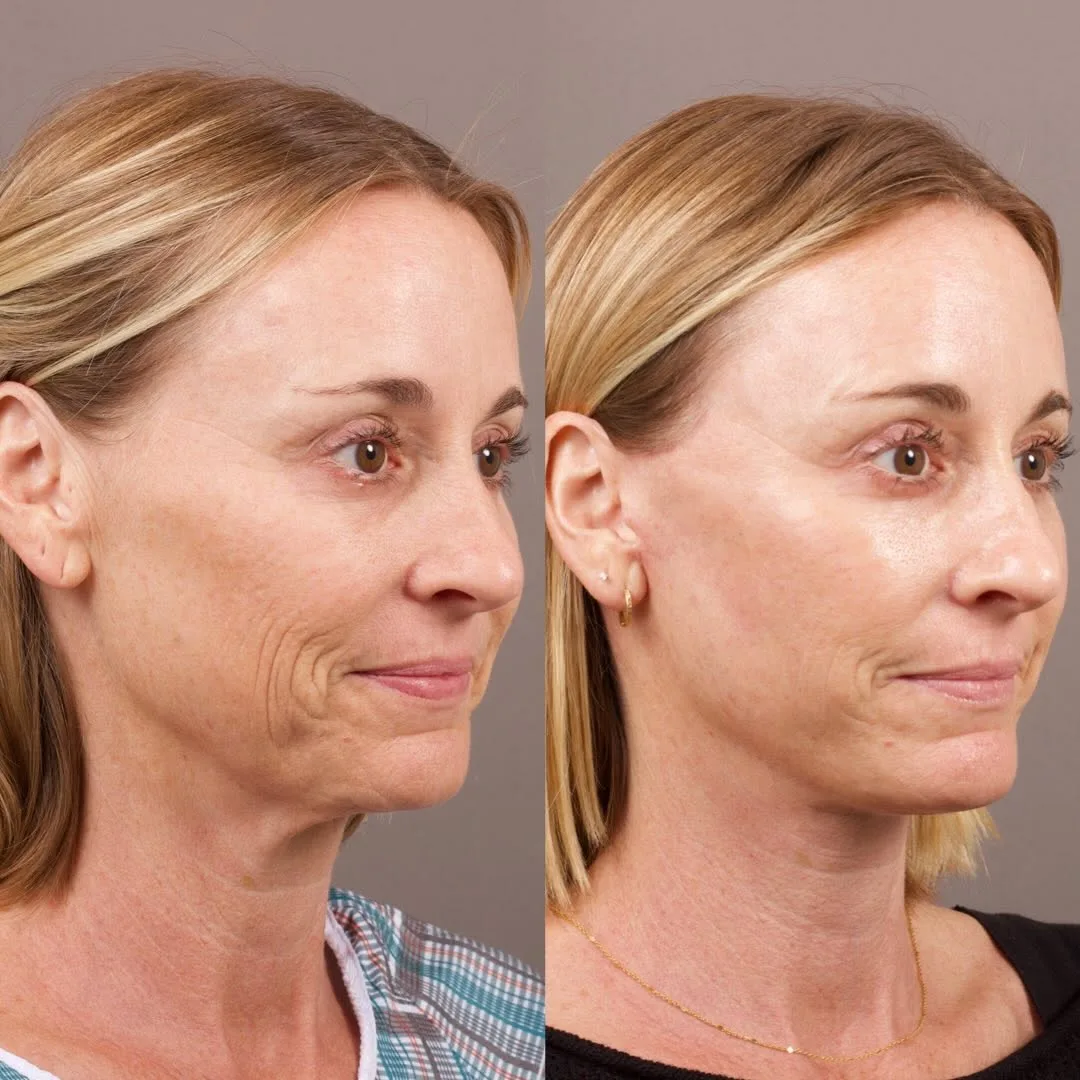 Before and after deep plane facelift — 52-year-old woman, right profile view, 7mo post-op by Dr. Marc Levin