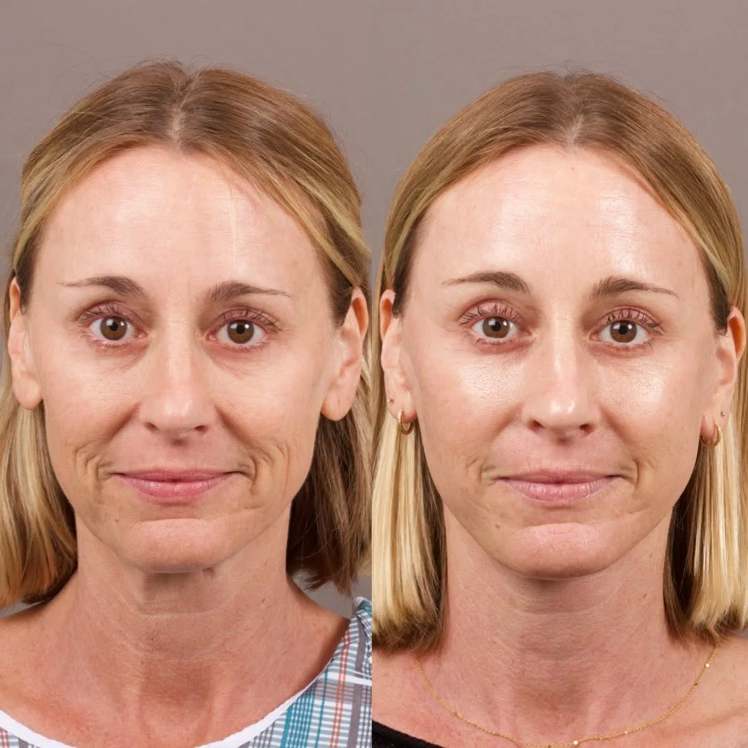 Before and after deep plane facelift — 48-year-old woman, frontal view, 7mo post-op by Dr. Marc Levin