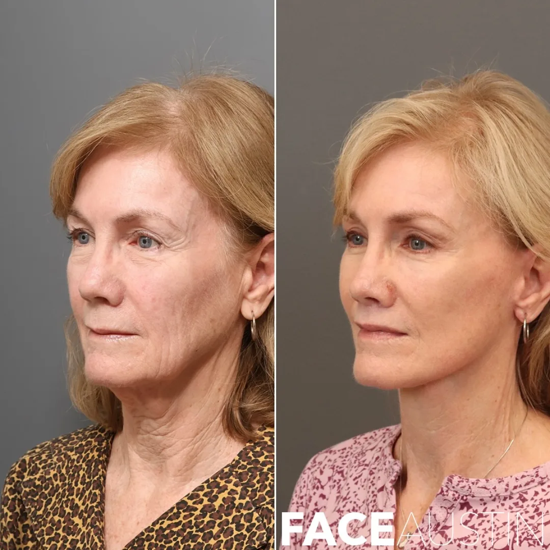 Before and after deep plane facelift — 58-year-old woman, three-quarter view, 8mo post-op by Dr. Marcelo Antunes