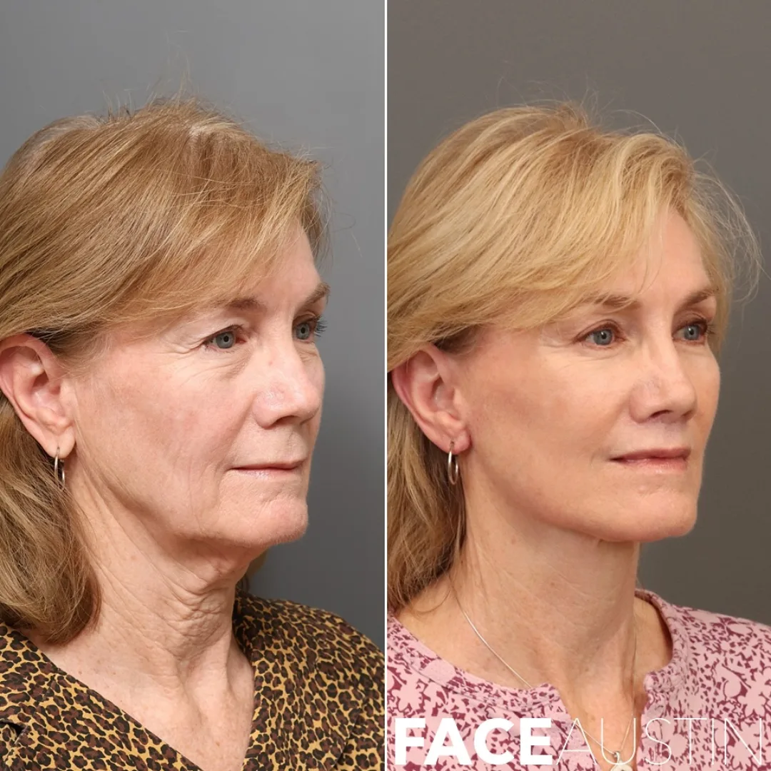 Before and after deep plane facelift — 58-year-old woman, three-quarter view, 8mo post-op by Dr. Marcelo Antunes