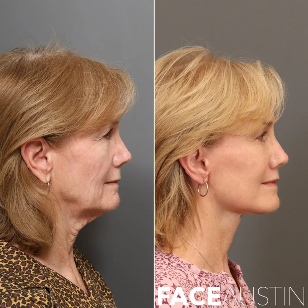 Before and after deep plane facelift — 58-year-old woman, right profile view, 8mo post-op by Dr. Marcelo Antunes