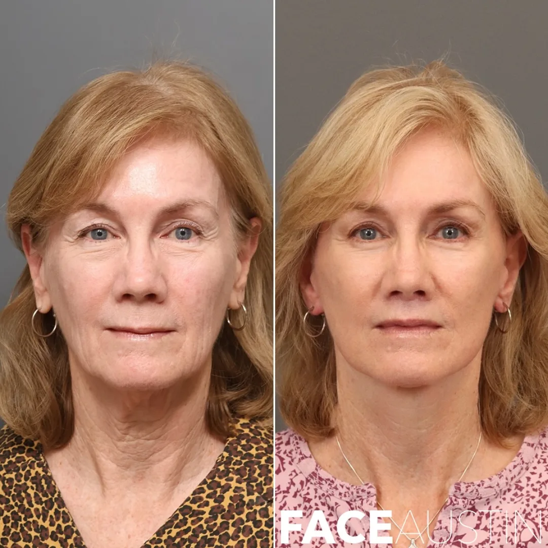 Before and after deep plane facelift — 58-year-old woman, frontal view, 8mo post-op by Dr. Marcelo Antunes