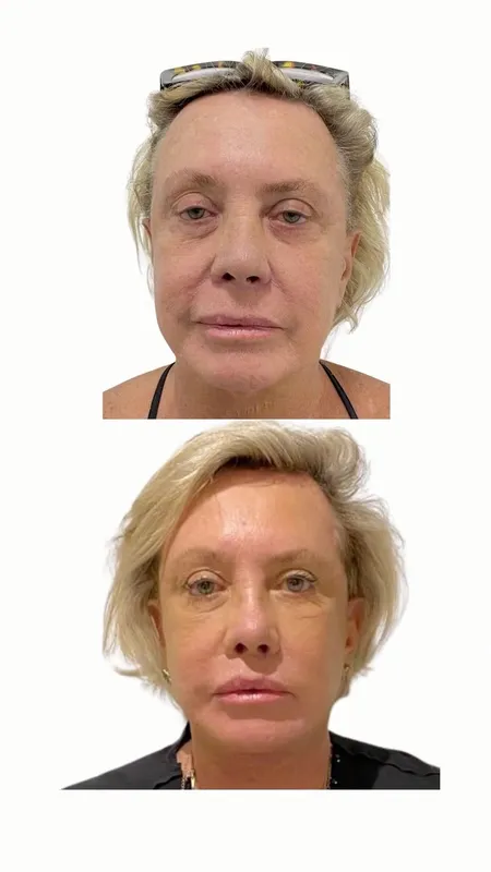 Before and after deep plane facelift — -1-year-old patient, frontal view by Dr. Marcelo Furlan