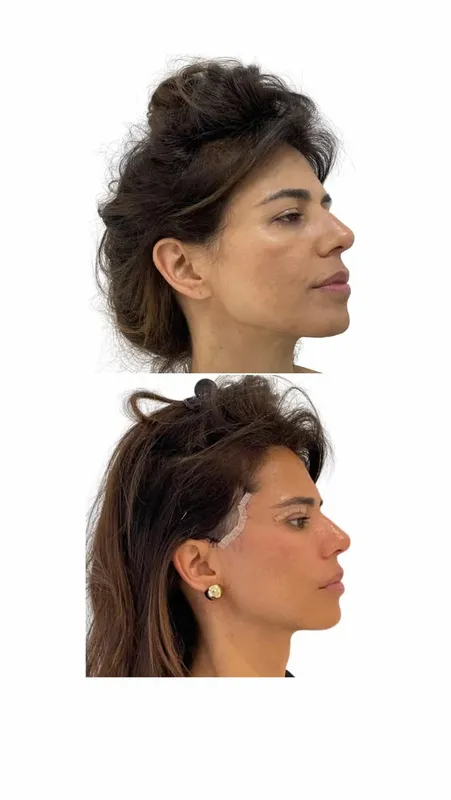Before and after deep plane facelift — -1-year-old patient, frontal view by Dr. Marcelo Furlan