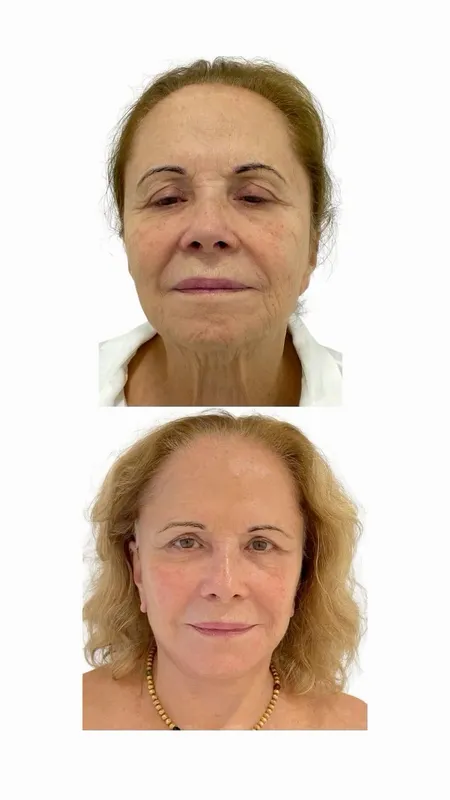 Before and after deep plane facelift — -1-year-old patient, frontal view by Dr. Marcelo Furlan