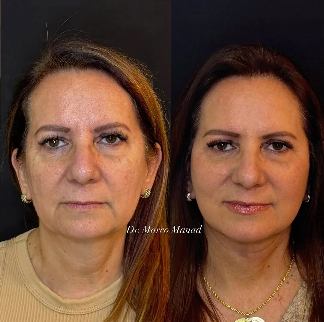Before and after — Dr. Marco Mauad