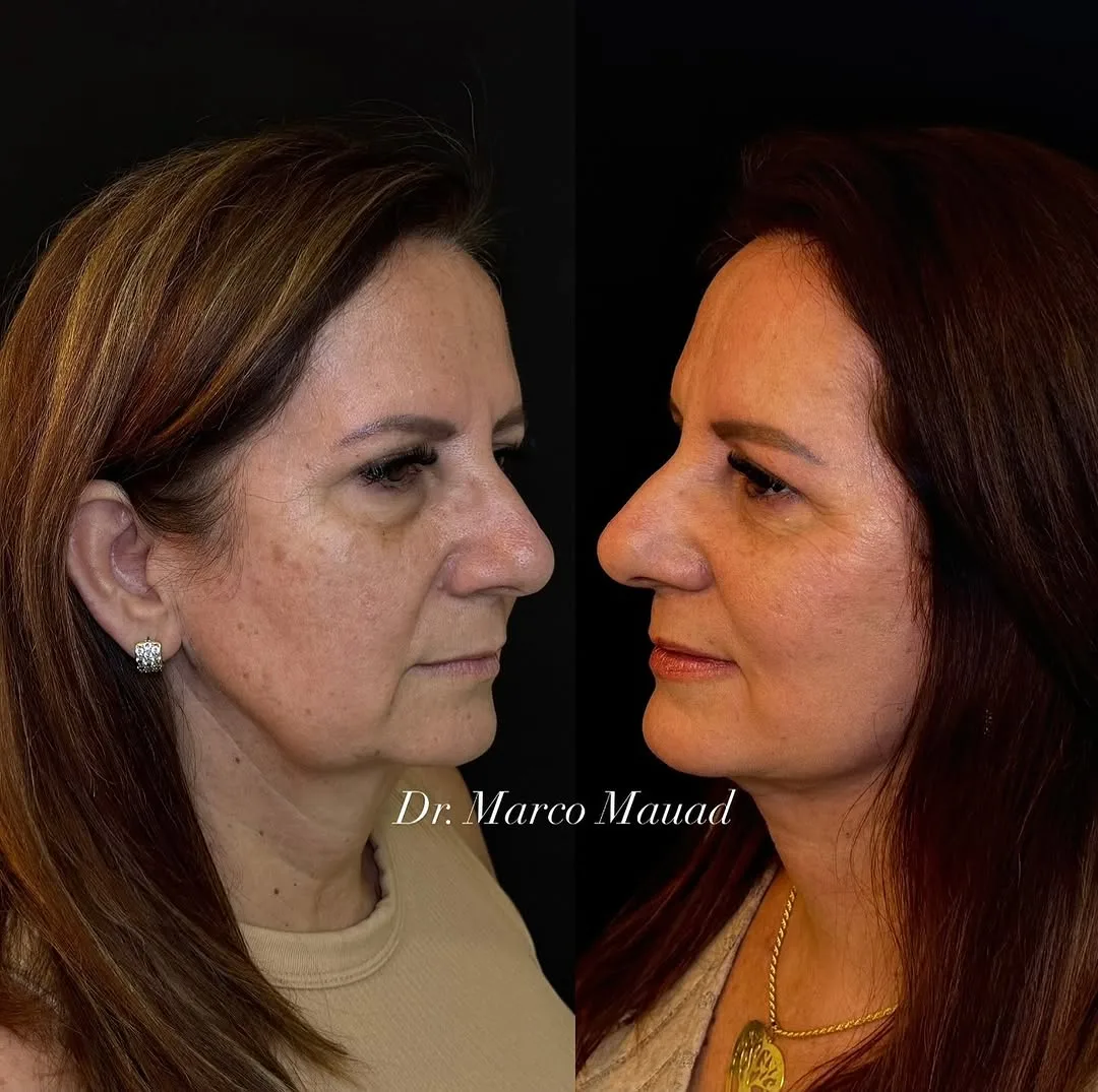 Before and after — Dr. Marco Mauad