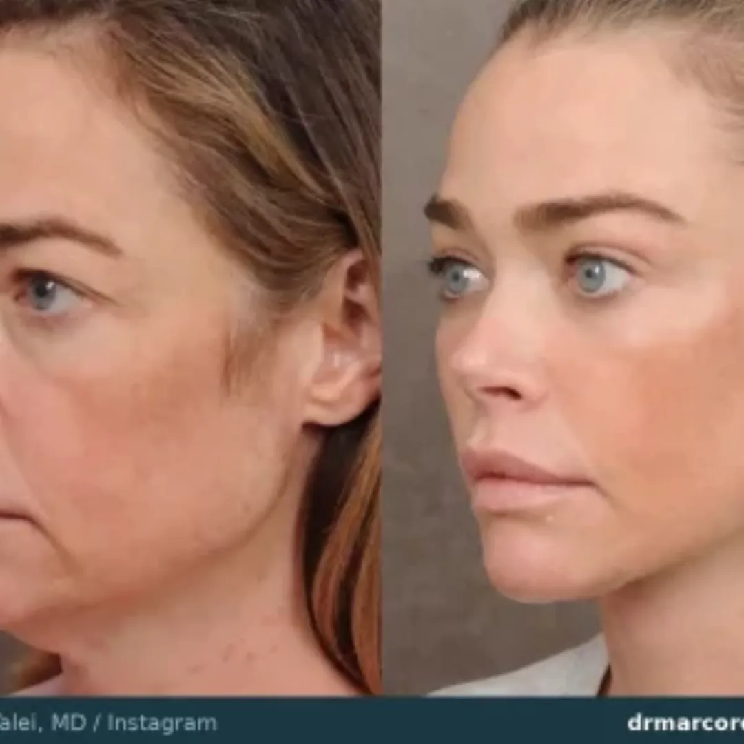 Before and after — Dr. Marco Romeo