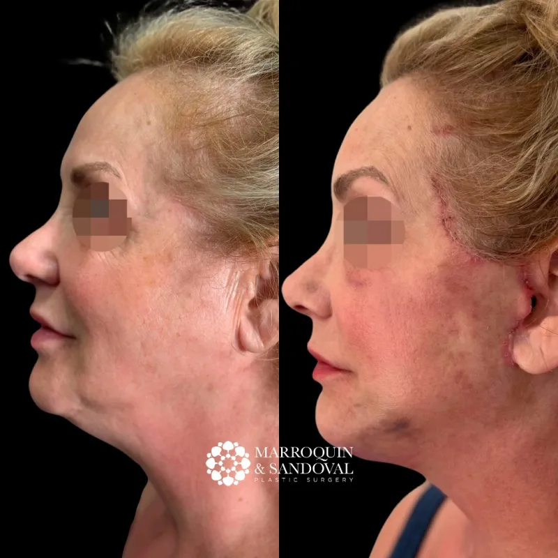 Before and after — Dr. Marco Tulio Marroquín