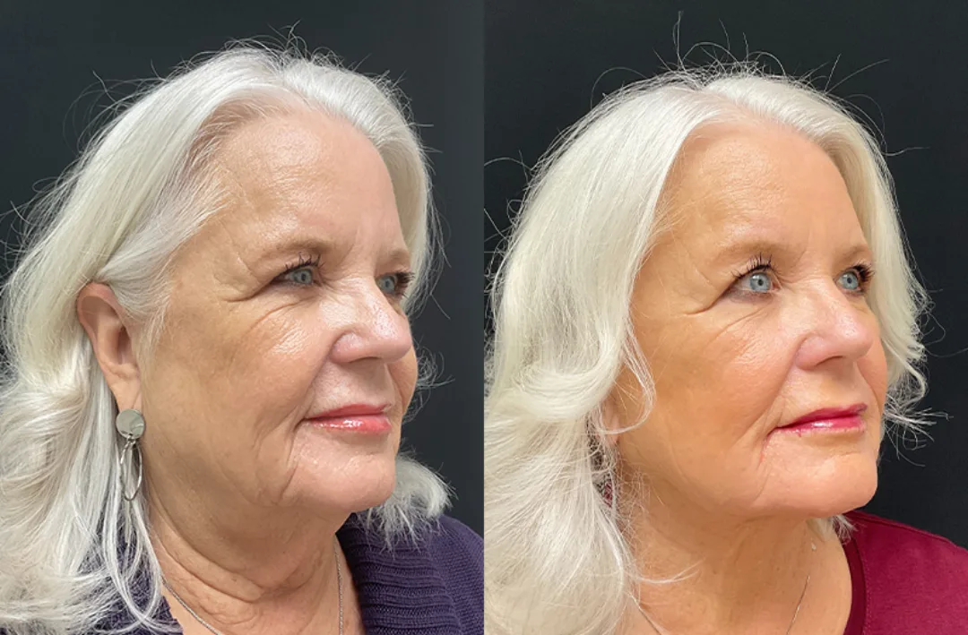 Before and after — Dr. Mario Yco