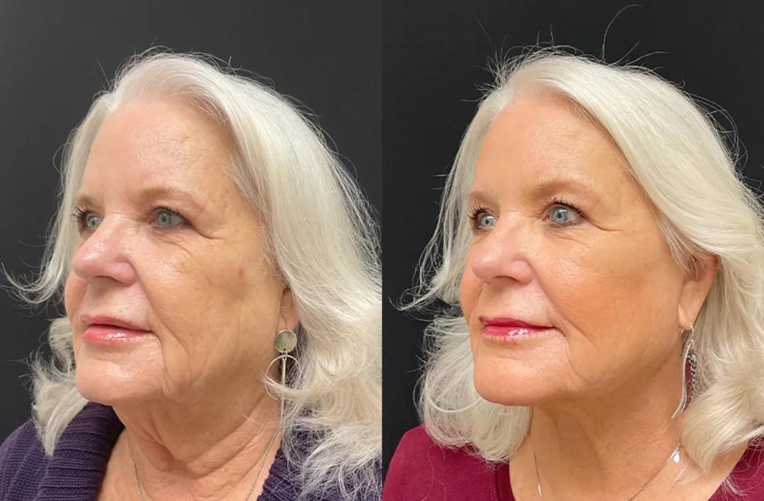 Before and after — Dr. Mario Yco
