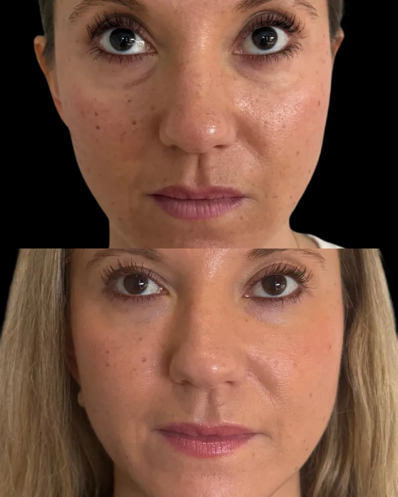 Before & After - Deep Plane Facelift by Dr. Marios Loucas