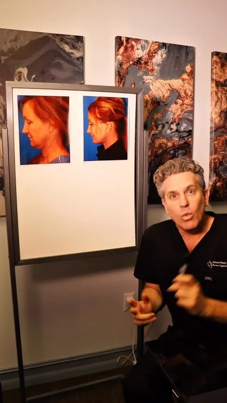 Before and after deep plane facelift, frontal view by Dr. Mark Avante