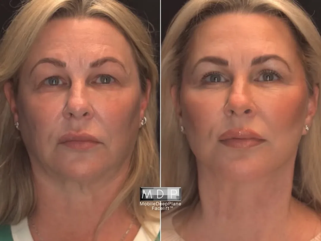 Before and after deep plane facelift — 52-year-old woman, frontal view, 6mo post-op by Dr. Mark Deuber