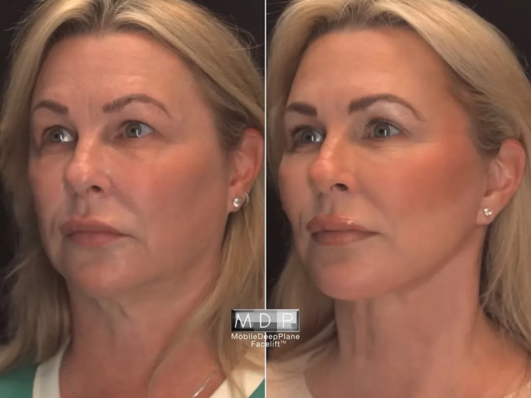 Before and after deep plane facelift — 52-year-old woman, oblique left view, 6mo post-op by Dr. Mark Deuber
