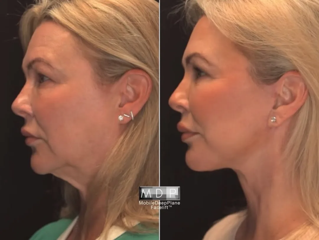 Before and after deep plane facelift — 48-year-old woman, left profile view, 6mo post-op by Dr. Mark Deuber
