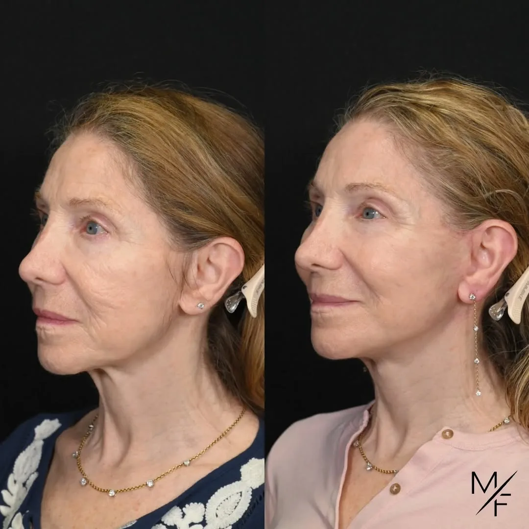 Before and after — Dr. Mark Fisher