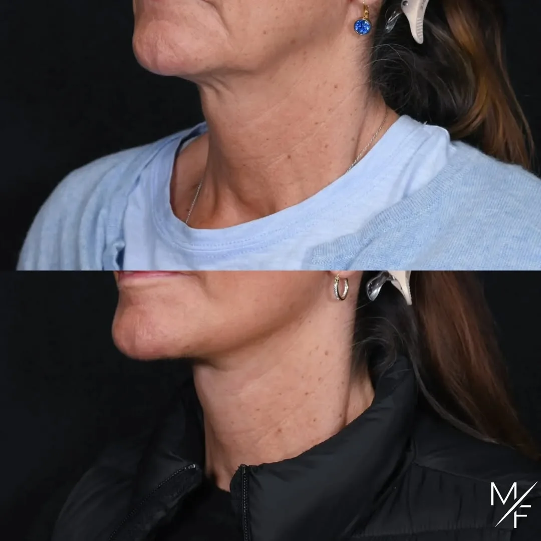 Before and after — Dr. Mark Fisher