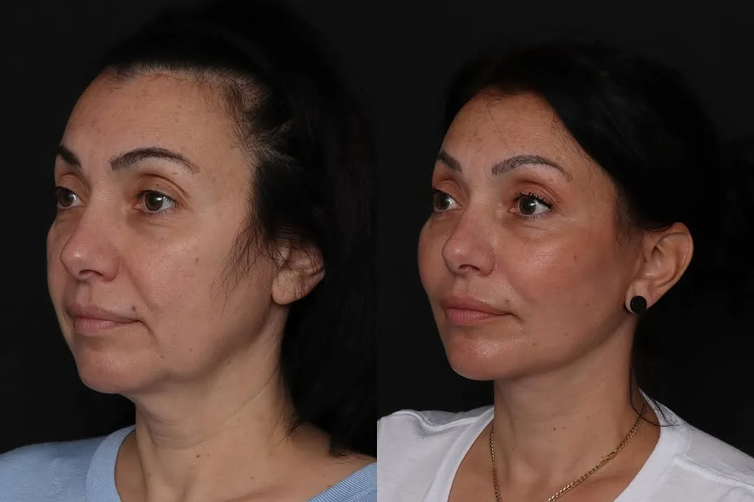 Before and after — Dr. Mark Glasgold