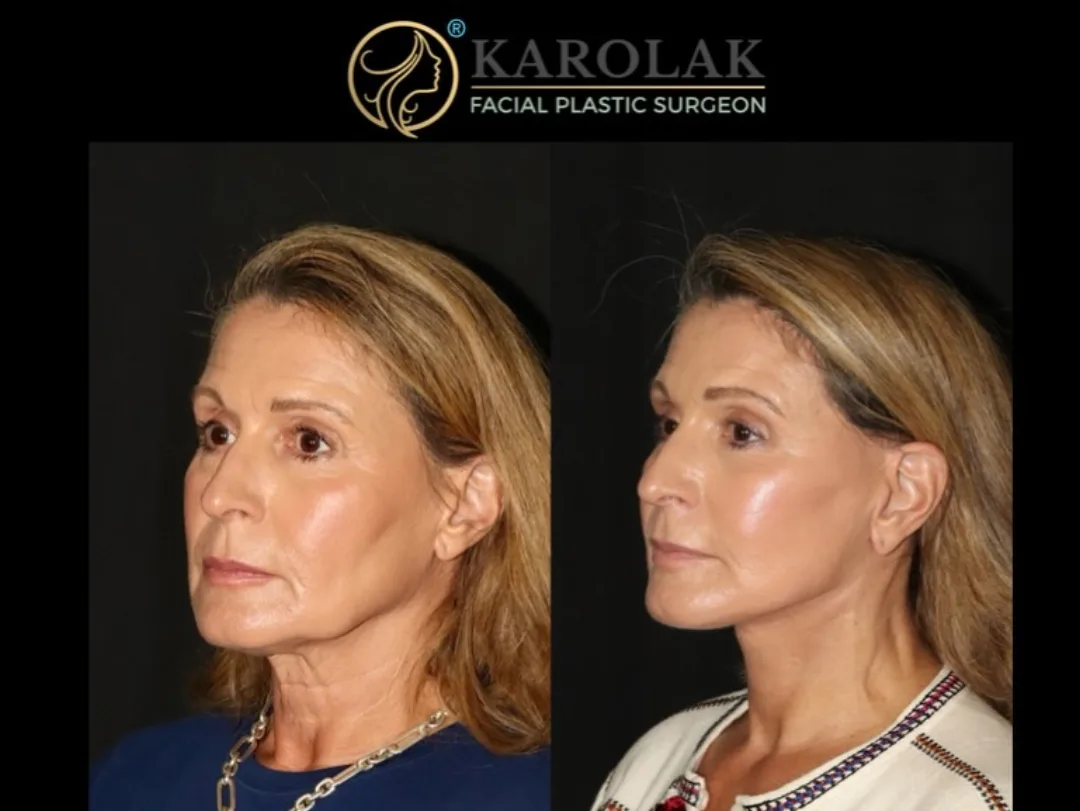 Before and after — Dr. Mark Karolak