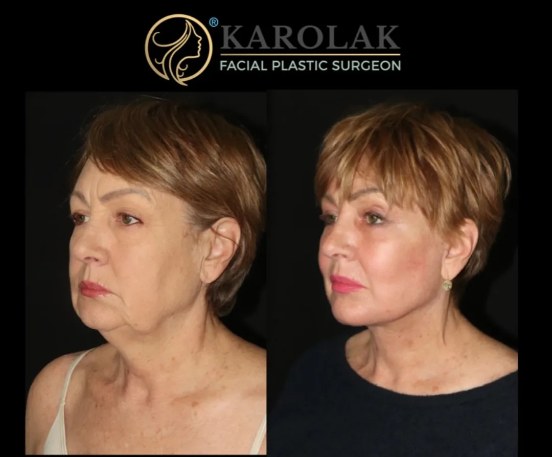 Before and after — Dr. Mark Karolak
