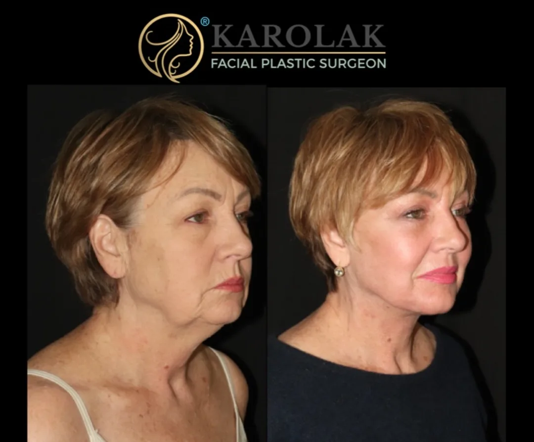 Before and after — Dr. Mark Karolak