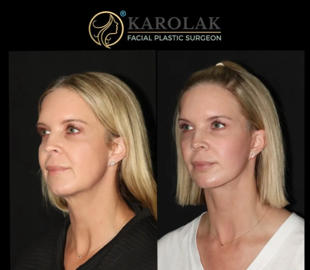 Before and after — Dr. Mark Karolak