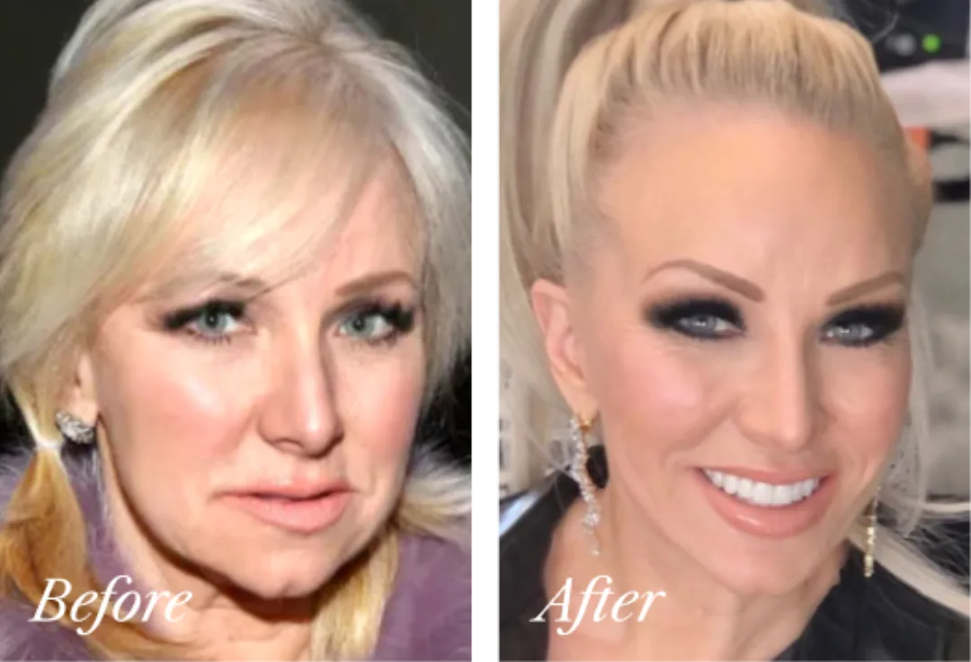 Before and after, Deep Plane Facelift