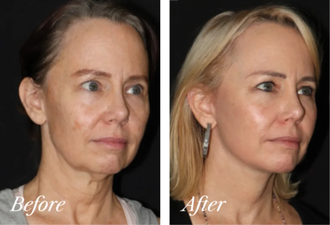 Before and after, Deep Plane Facelift