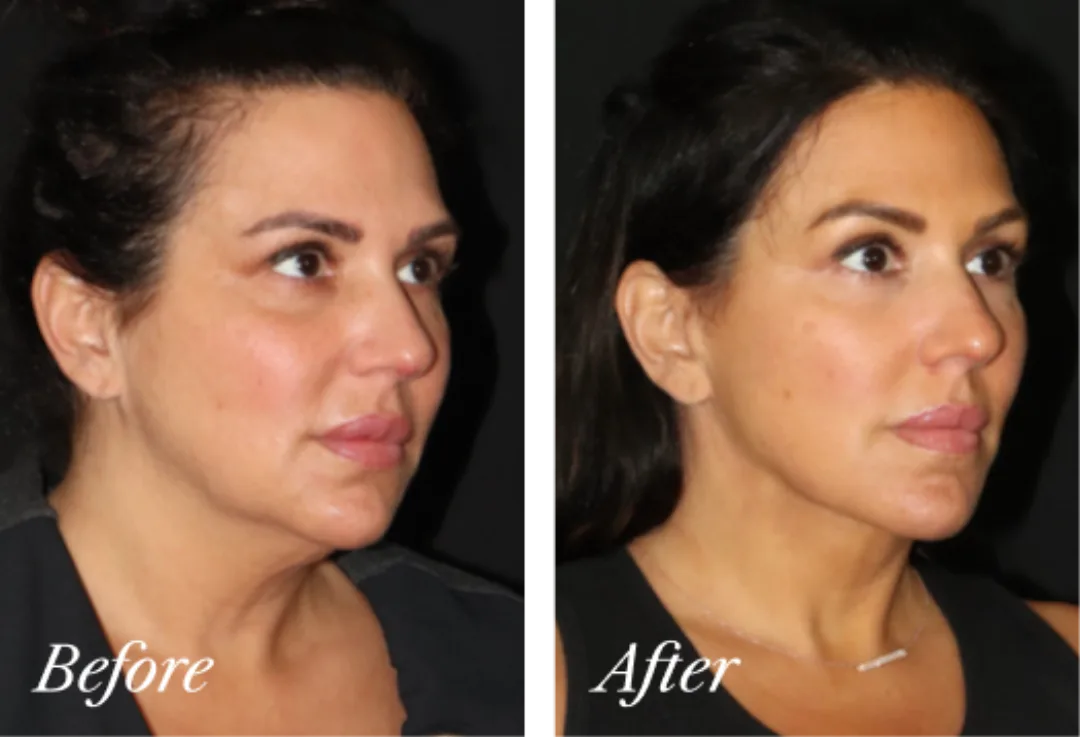 Before and after, Deep Plane Facelift