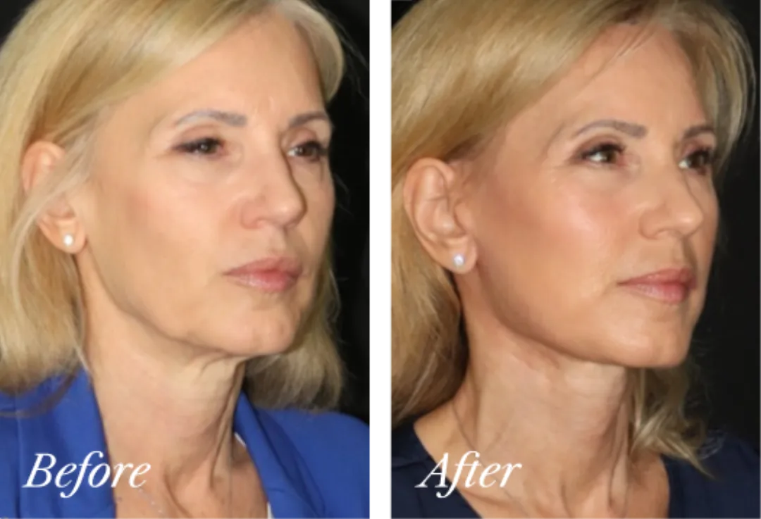 Before and after, Deep Plane Facelift