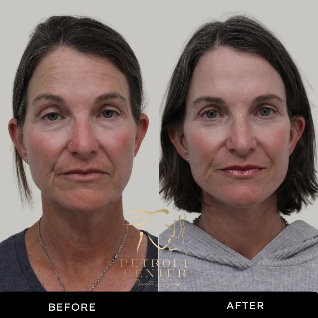 Before and after deep plane facelift — 55-year-old woman, frontal view, 6mo post-op by Dr. Mark Petroff