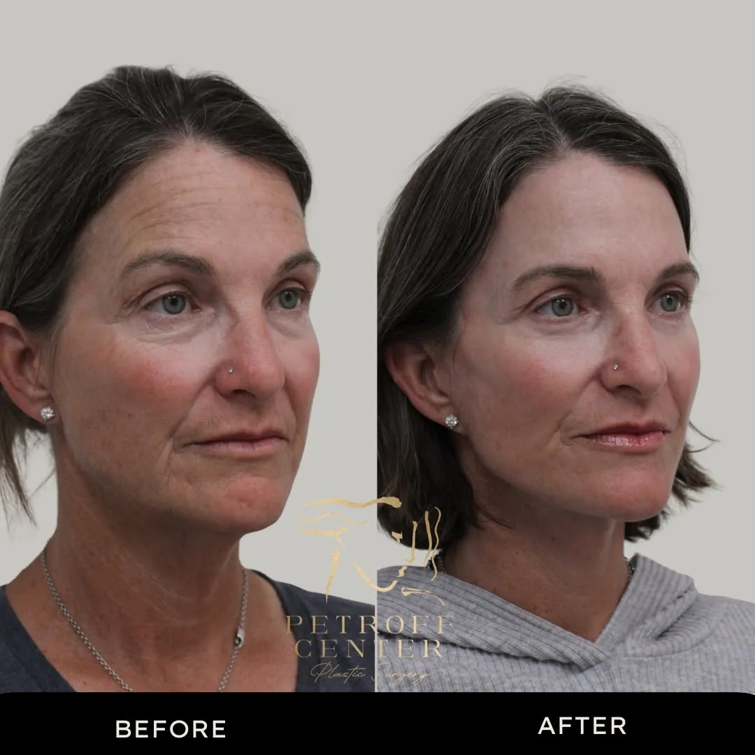 Before and after deep plane facelift — 55-year-old woman, oblique left view, 6mo post-op by Dr. Mark Petroff