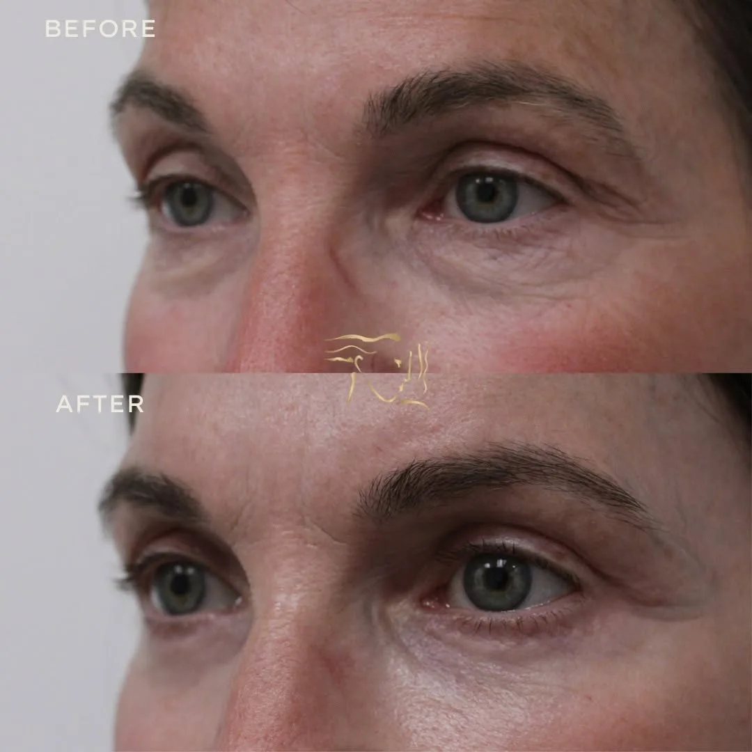 Before and after deep plane facelift — 55-year-old man, oblique right view, 6mo post-op by Dr. Mark Petroff