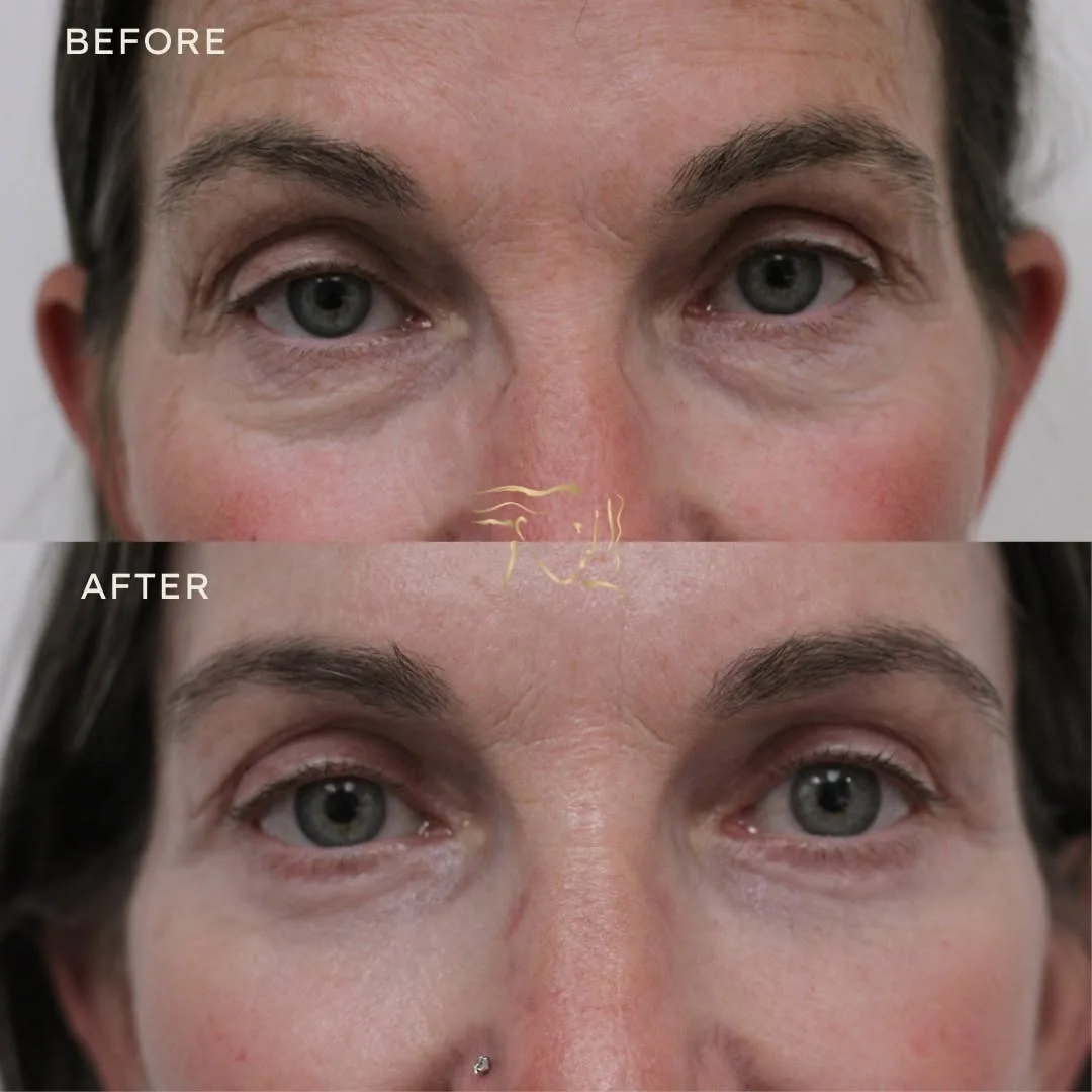 Before and after deep plane facelift — 45-year-old woman, frontal view, 6mo post-op by Dr. Mark Petroff