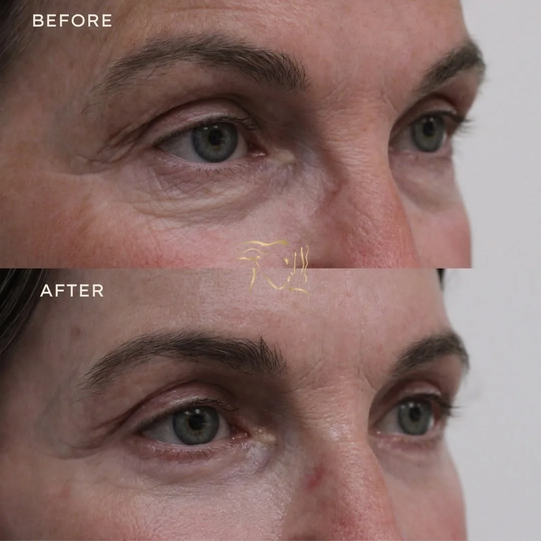 Before and after deep plane facelift — 55-year-old man, three-quarter view, 6mo post-op by Dr. Mark Petroff