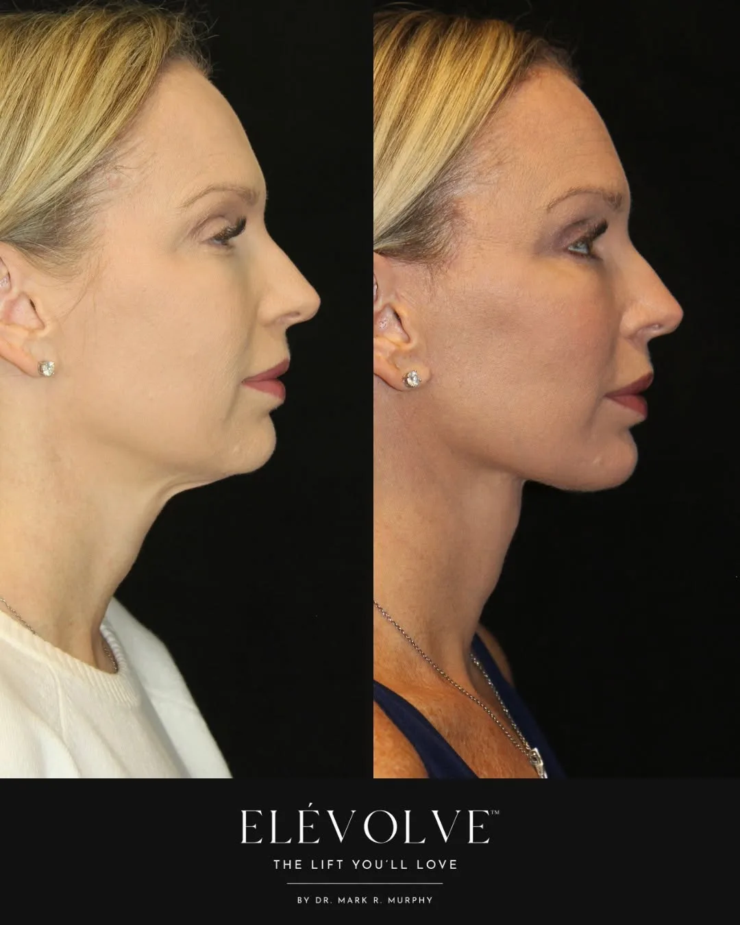 Before and after — Dr. Mark R. Murphy