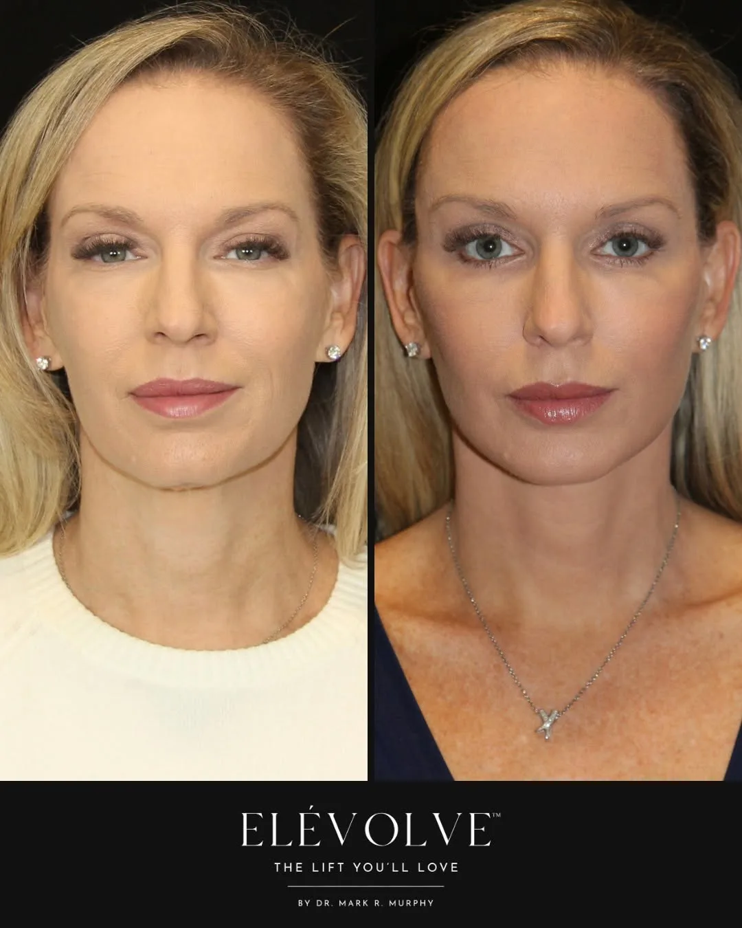 Before and after — Dr. Mark R. Murphy