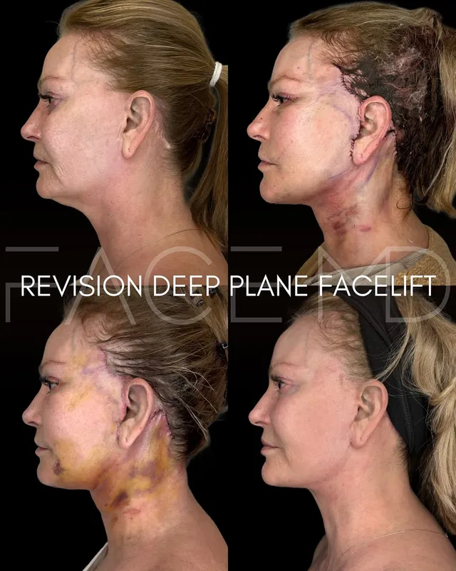 Before and after deep plane facelift, frontal view by Dr. Mark Samaha