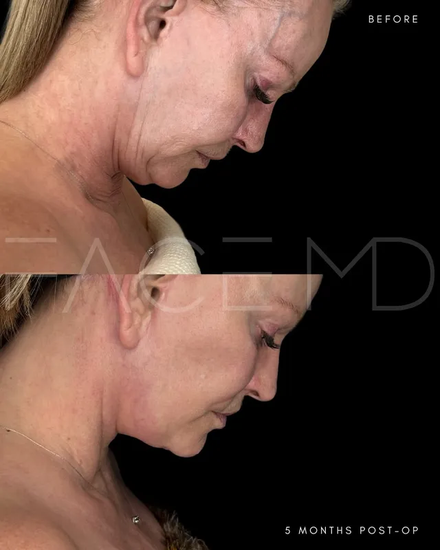 Before and after deep plane facelift, frontal view by Dr. Mark Samaha
