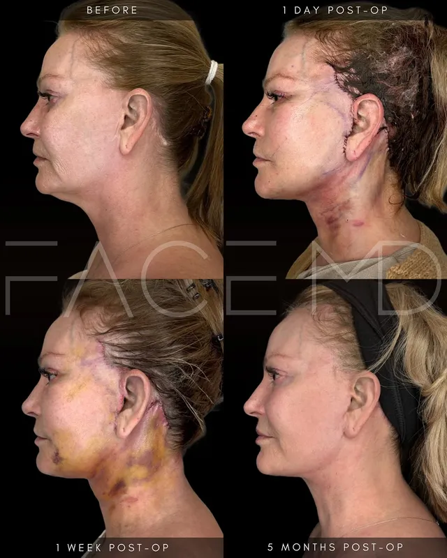 Before and after deep plane facelift, frontal view by Dr. Mark Samaha