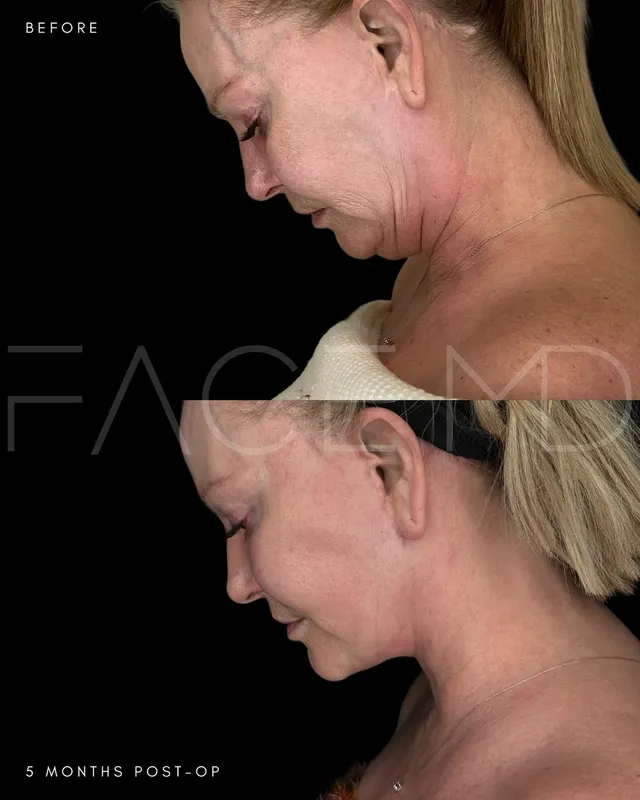 Before and after deep plane facelift, frontal view by Dr. Mark Samaha