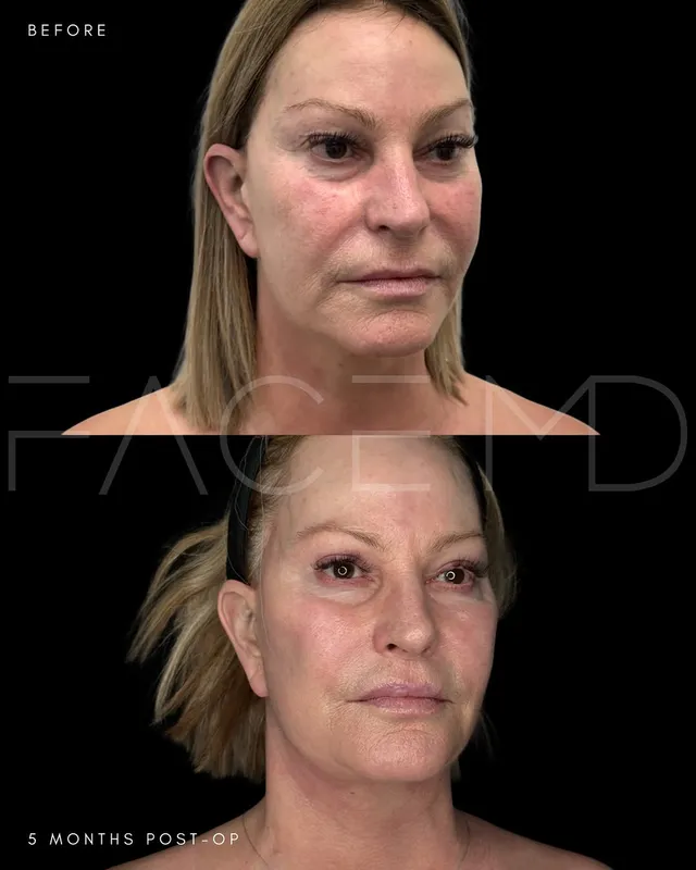 Before and after deep plane facelift, frontal view by Dr. Mark Samaha
