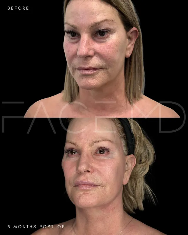 Before and after deep plane facelift, frontal view by Dr. Mark Samaha