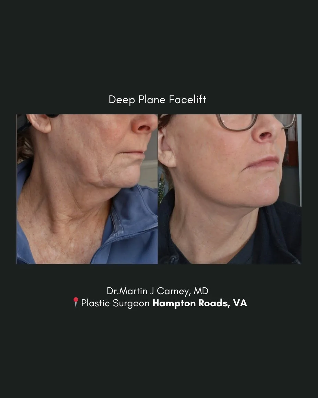 Before and after deep plane facelift — 58-year-old woman, three-quarter view, 1mo post-op by Dr. Martin Carney