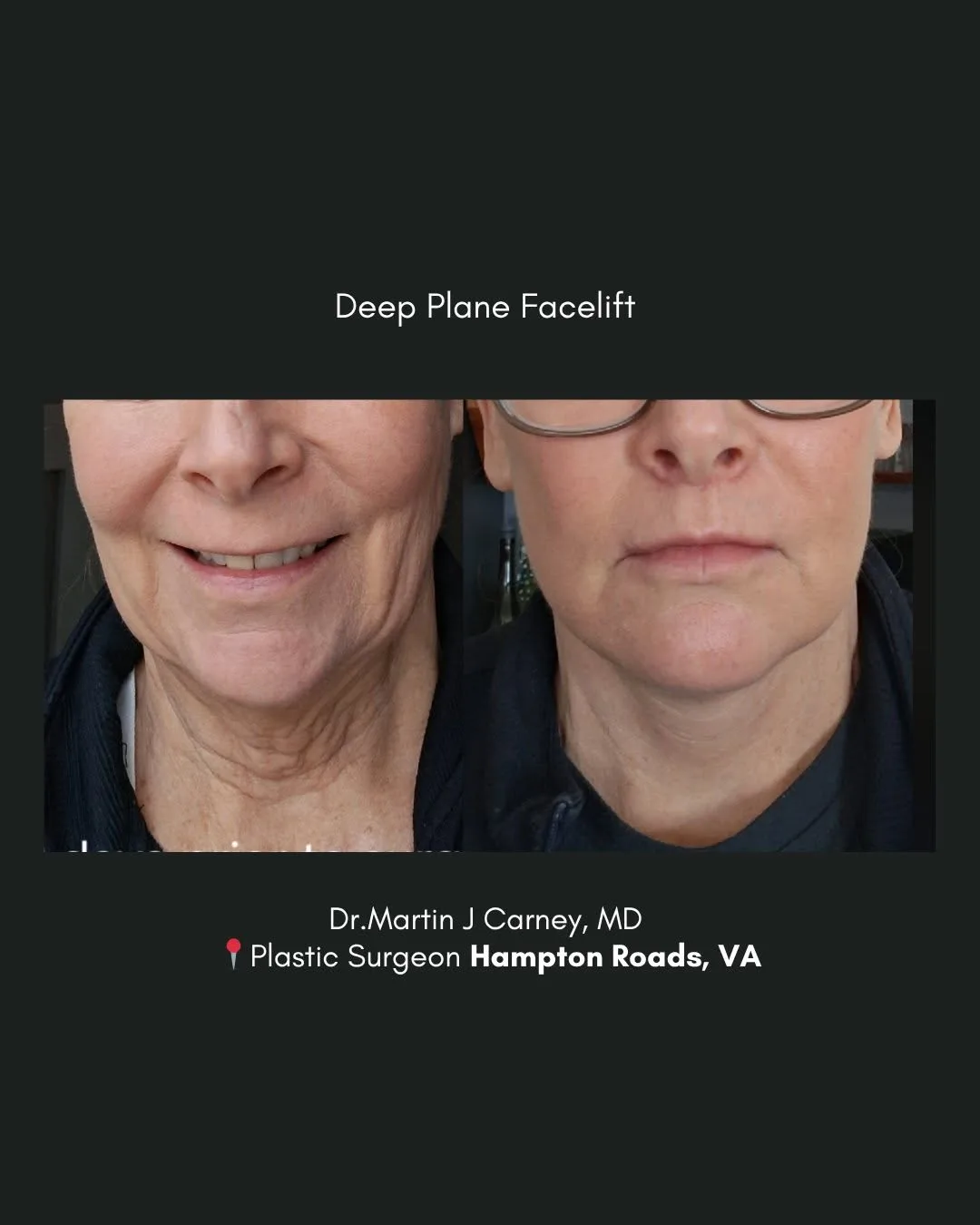 Before and after deep plane facelift — 58-year-old woman, frontal view, 1mo post-op by Dr. Martin Carney