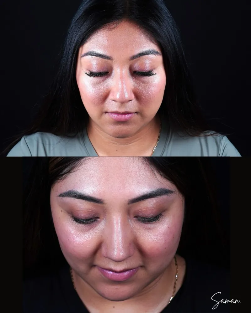 Before & After - Deep Plane Facelift by Dr. Masoud Saman