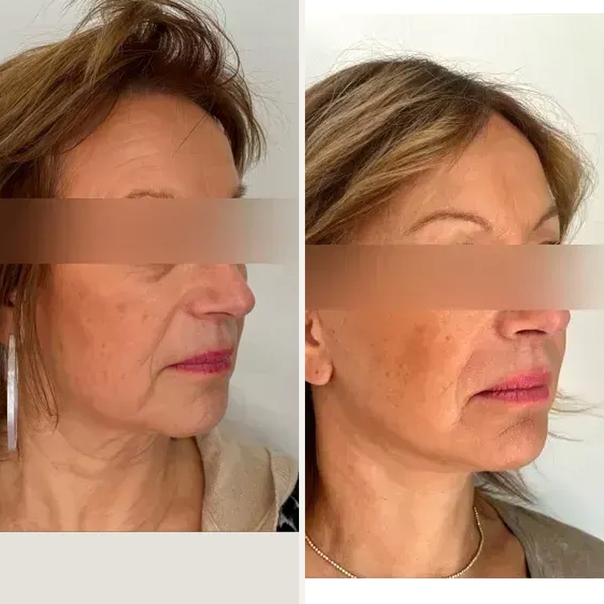 Before & After - Deep Plane Facelift by Dr. Matthieu Koppe