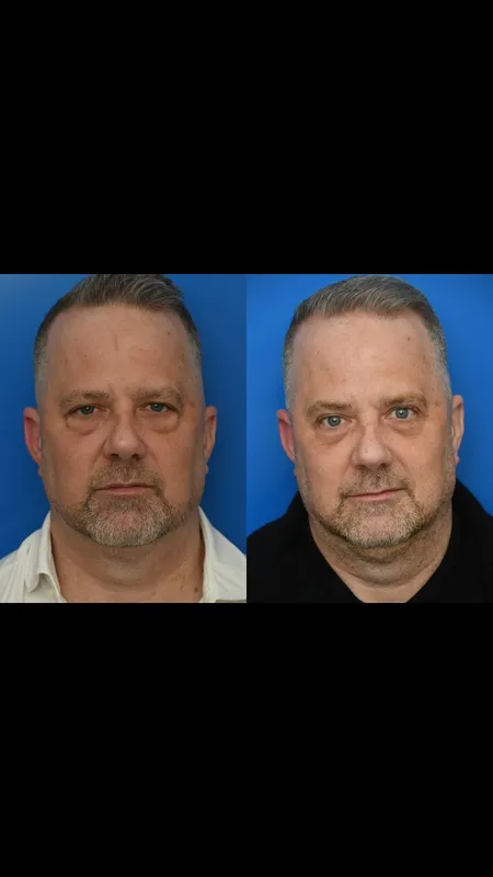 Before and after — Dr. Maurice Khosh