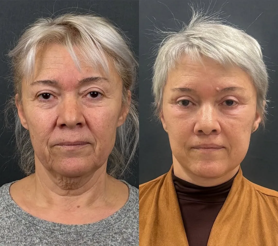 Before and after deep plane facelift — 65-year-old woman, frontal view, 6mo post-op by Dr. Mehmet Akbalık
